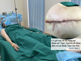 Bệnh nhân bị biến chứng nặng nề sau hút mỡ bụng (Ảnh: BSCC)