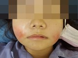 Khuôn mặt sưng tấy của người bệnh sau khi tiêm filler