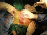 Các bác sĩ phẫu thuật ổ bụng cho bé gái bị thủng bụng, lộ toàn bộ ruột non (Ảnh - BVCC)