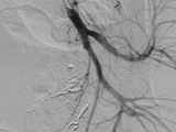 Hình ảnh sau nút mạch quanh động mạch trực tràng của bệnh nhân (Ảnh - BVCC)