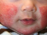 Trẻ bị viêm da cơ địa (Ảnh - BVCC)