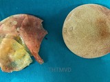 Túi ngực vỡ của chị V. được lấy ra sau 5 năm phẫu thuật nâng ngực (Ảnh - Bệnh viện Hữu nghị Việt Đức)