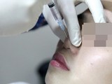 Ngưng tim nghi do phẫu thuật nâng mũi: Bệnh nhân đã tỉnh