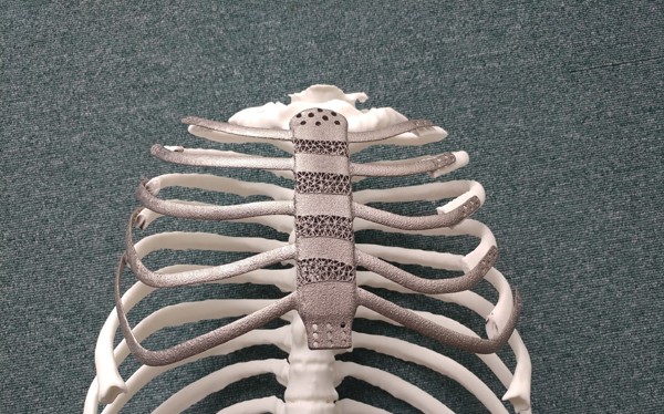 Ca ghép xương ngực nhân tạo bằng công nghệ in 3D đầu tiên tại Hàn Quốc. Ảnh: koreabiomed.com 