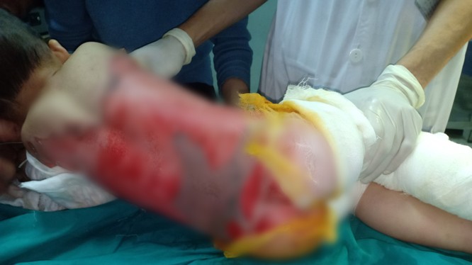 Trẻ nhỏ bị bỏng nặng đang điều trị tại Bệnh viện đa khoa tỉnh Tuyên Quang