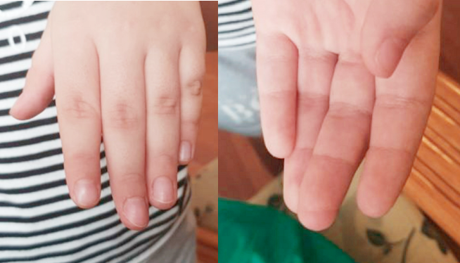 Hình ảnh búp ngón tay của bệnh nhi sau mổ. Ảnh: BVCC