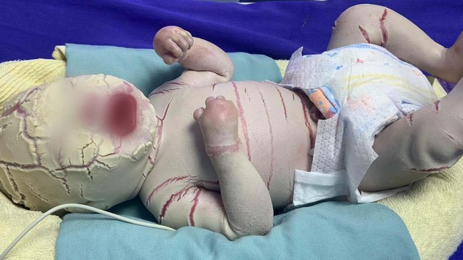 Bé trai sinh non 34 tuần bị mọc sừng khắp cơ thể (Ảnh: Bệnh viện Sản Nhi Quảng Ninh) 