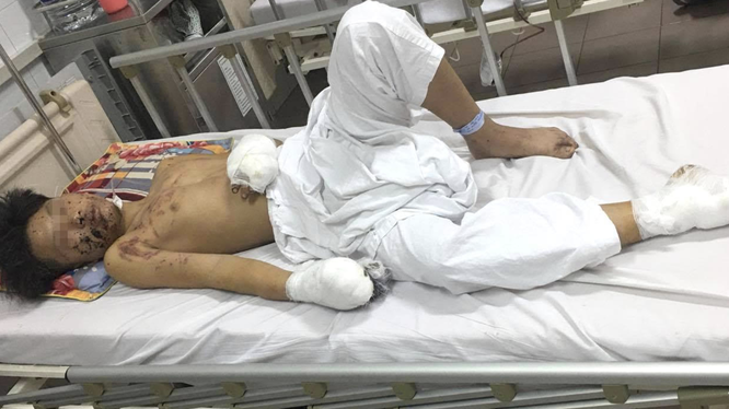 Thiếu niên 15 tuổi chấn thương nặng vì pháo tự chế phát nổ (Ảnh: BVCC) 
