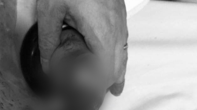 Bàn tay trái của bé gái bị dập nát vì cho vào máy xay hoa quả (Ảnh - BVCC) 
