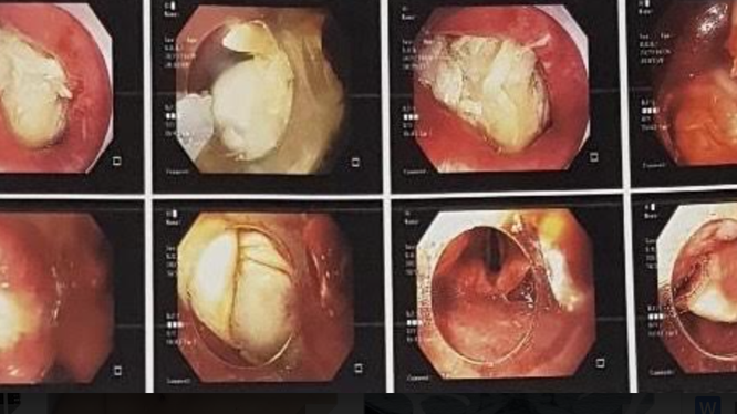 Hình ảnh xương gà mắc trong cổ họng bệnh nhân (Ảnh - BVCC) 