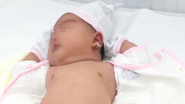 Bé gái chào đời nặng 5.2kg tại Bệnh viện Quận 11