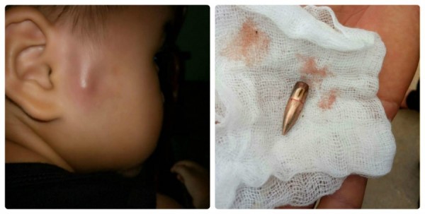 Cháu bé ở trường mầm non Họa Mi - thị trấn Gia Khánh - bị đạn bắn trúng. Ảnh: VTV 