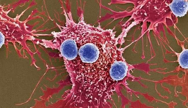 Liệu pháp mới được thông qua đột phá ở chỗ sử dụng các tế bào T đã chỉnh gen (xanh dương) để tấn công tế bào ung thư (màu đỏ) (Ảnh: Science Source)