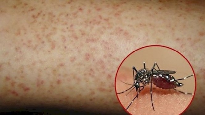 Đà Nẵng vừa phát hiện ca mắc virus Zika trên địa bàn phường Hòa Khánh Bắc, quận Liên Chiểu (ảnh minh họa)