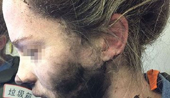Một nữ hành khách người Australia đã bị bỏng vì tai nghe Apple phát nổ