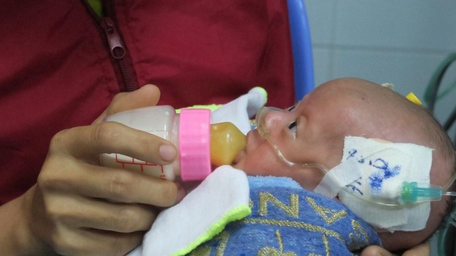 Em bé sơ sinh mới chỉ 1,6 kg đã được cứu cống sau 2 ca phẫu thuật tim "nghẹt thở"