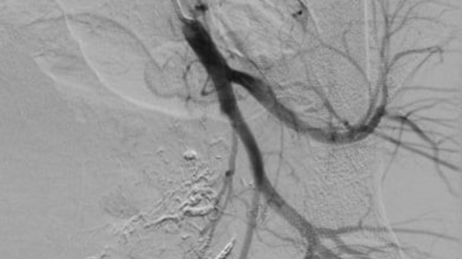Hình ảnh sau nút mạch quanh động mạch trực tràng của bệnh nhân (Ảnh - BVCC) 
