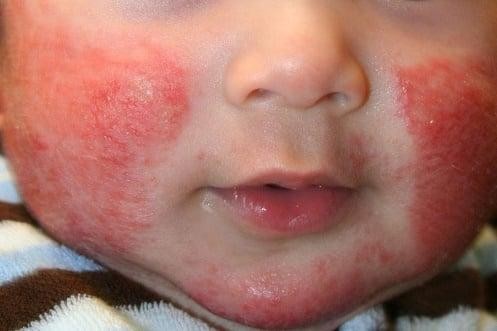 Trẻ bị viêm da cơ địa (Ảnh - BVCC) 