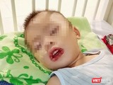 Bé trai không may bị uống nhầm thuốc tẩy bồn cầu, dẫn tới loét miệng và thực quản, dạ dày (Ảnh: BVCC)