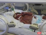 Em bé Bình An đang được điều trị tích cực tại Bệnh viện Phụ sản Trung ương sáng 24/5.
