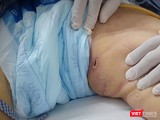 Vết loét điển hình trên vùng bẹn của bệnh nhân sốt mò - một dấu hiệu để phân biệt sốt mò và các bệnh truyền nhiễm khác (ảnh bệnh viện cung cấp)