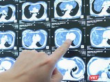 Hình ảnh khối u khổng lồ trong khoang ngực của bệnh nhân M.
