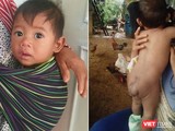 Bé trai 7 tháng tuổi người dân tộc Châu Mạ mang khối u khổng lồ ở mông