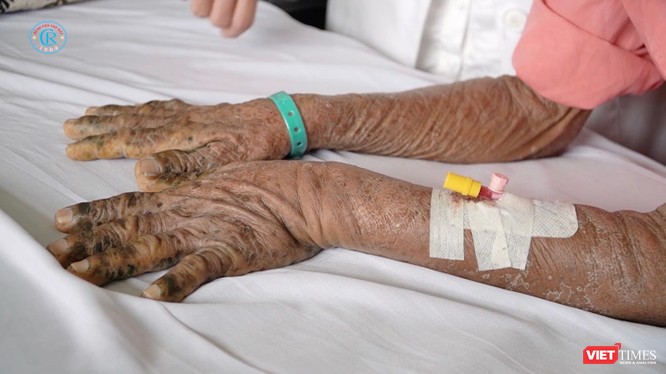 Hai tay của một nạn nhân nhiễm độc thuốc nam điều trị tại Bệnh viện Chợ Rẫy