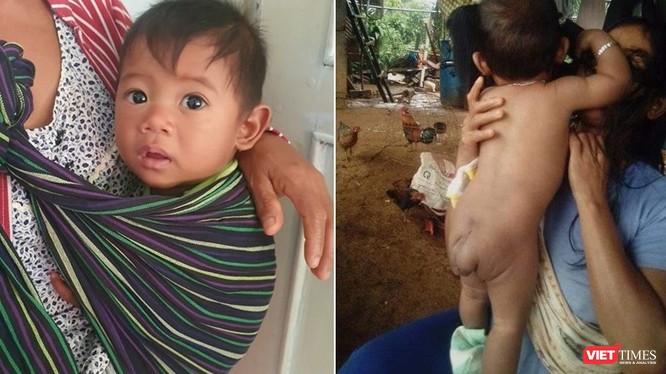Bé trai 7 tháng tuổi người dân tộc Châu Mạ mang khối u khổng lồ ở mông