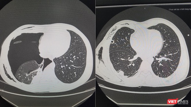Phim chụp CT phổi của bệnh nhân trước và sau khi phẩu thuật