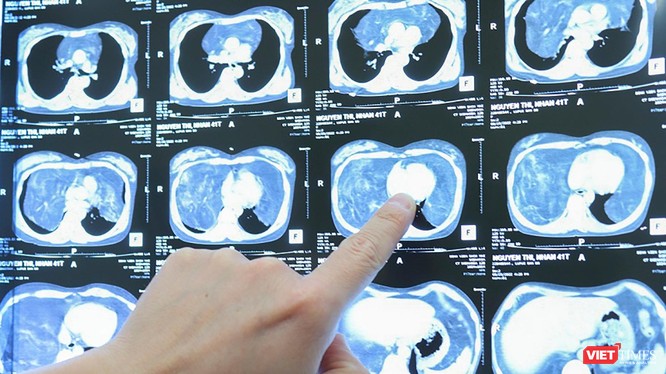 Hình ảnh khối u khổng lồ trong khoang ngực của bệnh nhân M.