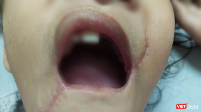 Tổn thương vùng miệng của bé T. đã được các bác sĩ xử trí.
