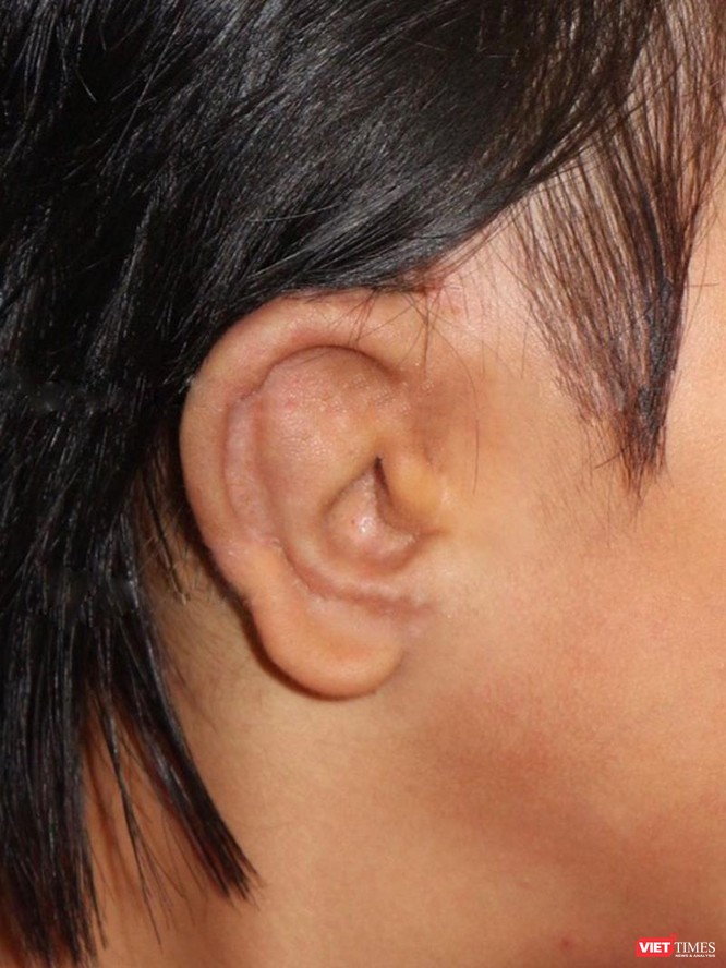 Vành tai của T. sau khi được phẫu thuật tạo hình thành công
