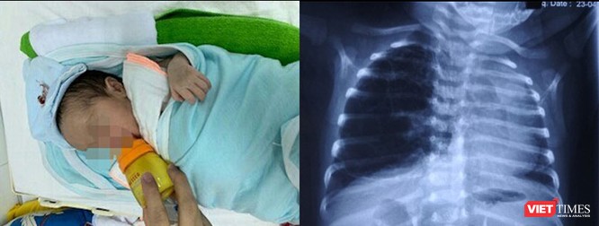 Trẻ khò khè, hay bị viêm phổi: Có thể đã bị dị dạng đường thở ảnh 1