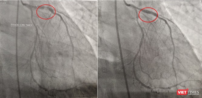 Kết quả chụp DSA mạch vành: bán tắc đoạn gần LAD do huyết khối, can thiệp và đặt stent cho bệnh nhân