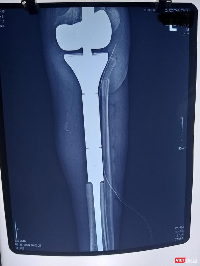 Ảnh chụp đoạn xương và khớp nhân tạo trên phim X quang sau phẫu thuật