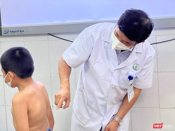 Tình cờ phát hiện hàng loạt cháu bé bị vẹo cột sống nghiêm trọng khi đến khám hậu COVID-19 ảnh 1