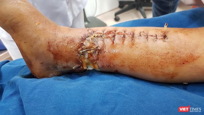 Phẫu thuật thành công cứu chân của bé trai bị tai nạn máy xúc dập nát ảnh 1