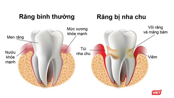 Mất răng do bệnh nha chu (Ảnh: cung cấp) 