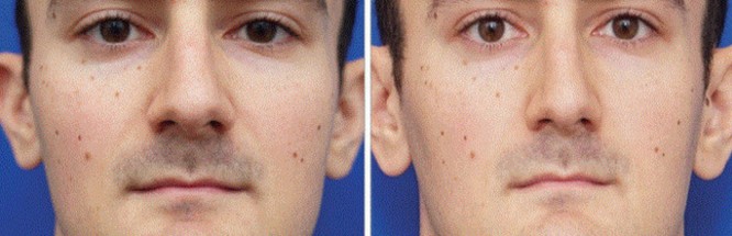 Chụp ảnh tự sướng nhiều sẽ làm mũi bị to ra? ảnh 1