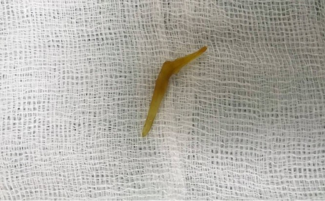 Mảnh xương cá đâm thủng ruột non bệnh nhân đã được lấy ra sau ca mổ