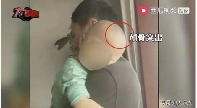 Trung Quốc: lại xuất hiện “Trẻ đầu to” do sữa rởm gây chấn động dư luận ảnh 1
