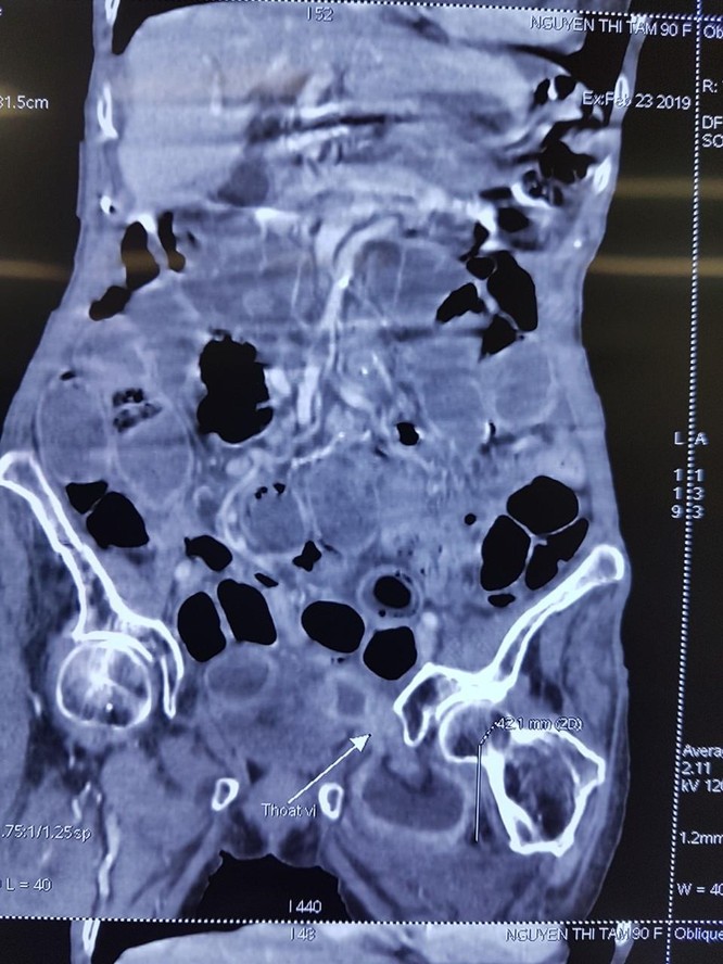 Hình ảnh chụp CT của bệnh nhân
