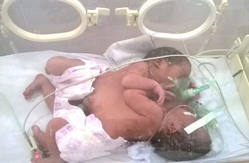 Cặp song sinh dính liền khi được điều trị tại Bệnh viện Việt Đức