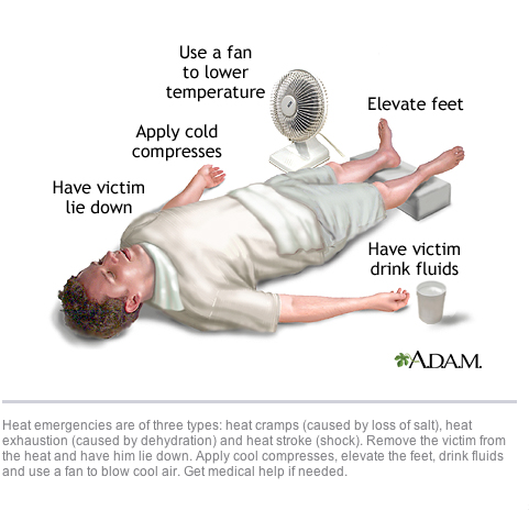 Cấp cứu người bị sốc nhiệt: Cho nạn nhân nằm, hạ nhiệt và uống nước