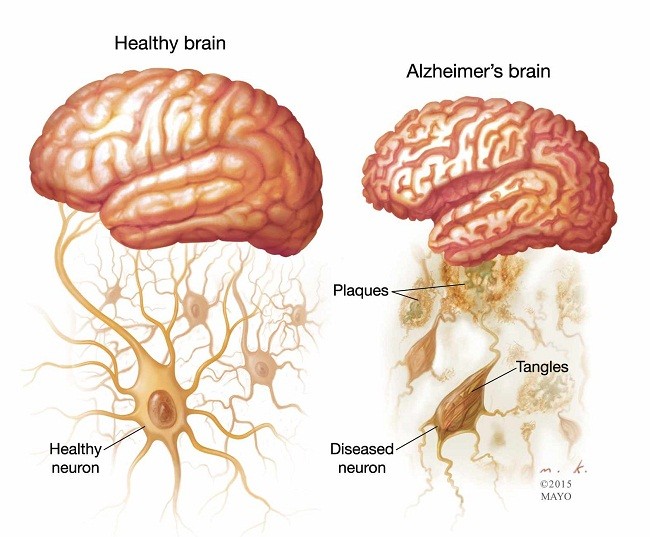 Đã tìm ra cách điều trị bệnh mất trí nhớ tạm thời Alzheimer’s ảnh 1