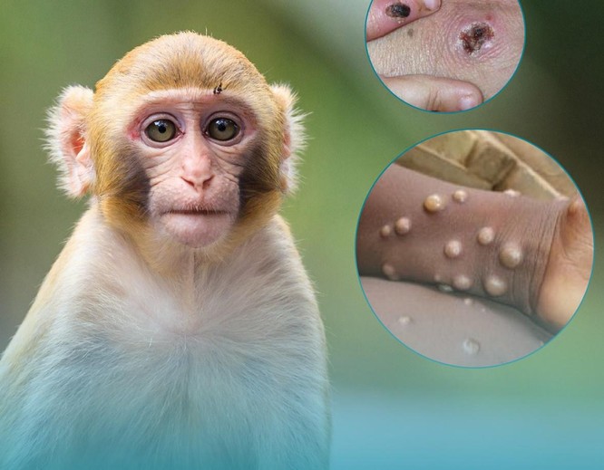 Bộ Y tế: Chính thức công bố phác đồ điều trị bệnh đậu khỉ ở người