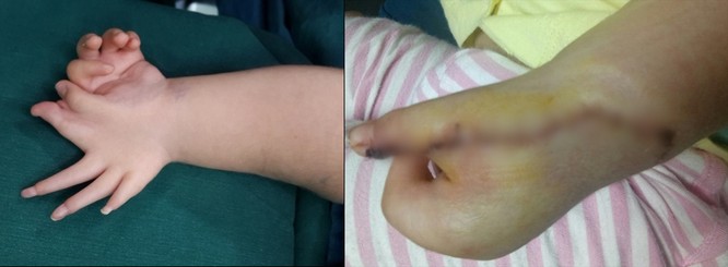 20 bệnh nhi được hỗ trợ khám dị tật bàn tay, bàn chân ảnh 1