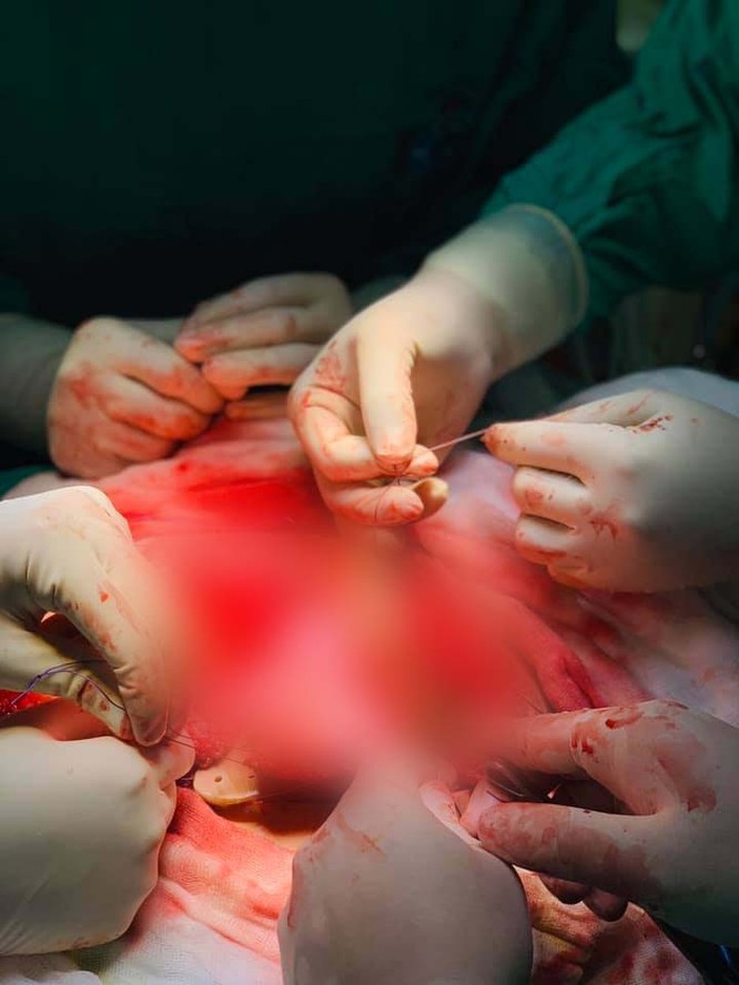 Việt Nam là nước thứ 2 trên thế giới phẫu thuật thay xương bả vai bằng vật liệu sinh học PEEK ảnh 2