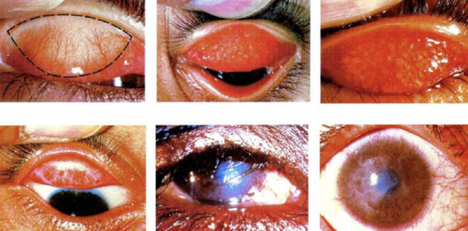 10 ngày sau lũ, nguy cơ bệnh viêm kết mạc và đau mắt hột tấn công người dân ảnh 2